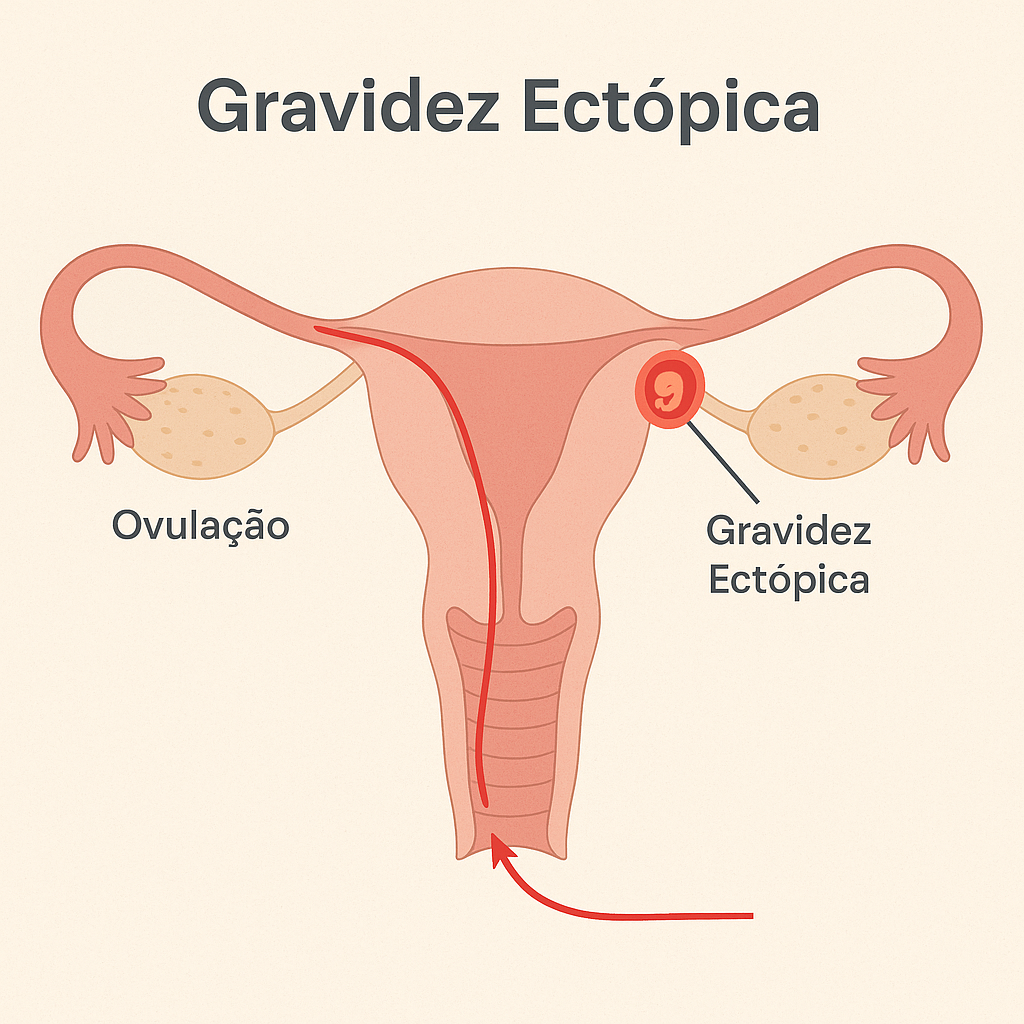 Ilustração mostrando o trajeto normal do óvulo até o útero e a localização da gravidez ectópica nas trompas de Falópio.