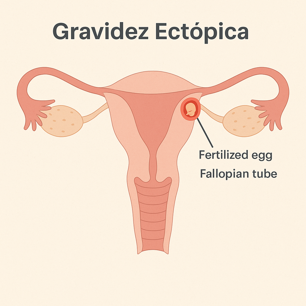 gravidez ectópica
