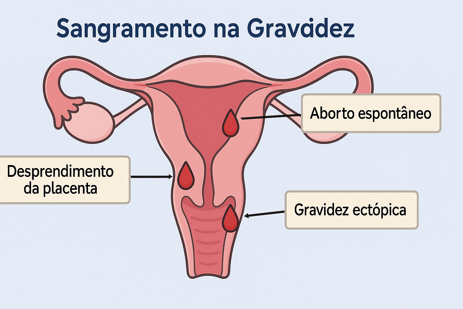 Diagrama anatômico do útero grávido destacando as principais causas de sangramento durante a gestação incluindo implantação, alterações cervicais e descolamento placentário