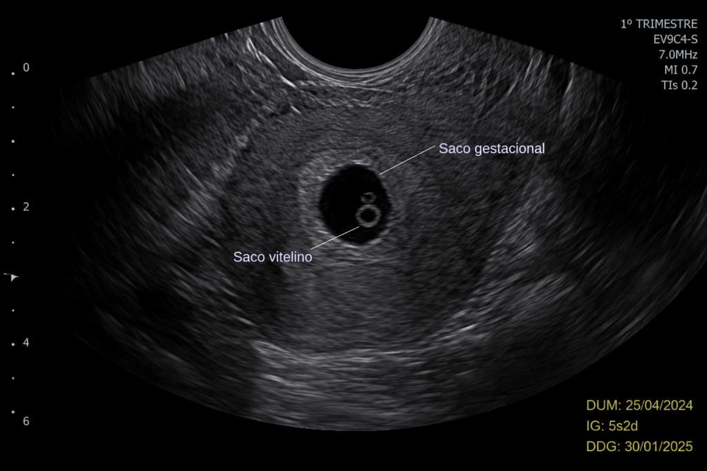 saco gestacional no ultrassom – imagem do primeiro trimestre da gravidez